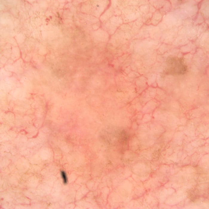 3c1a391f-7093-445a-a5e7-b8d8320d7d9f-case_photos-Dermoscopy