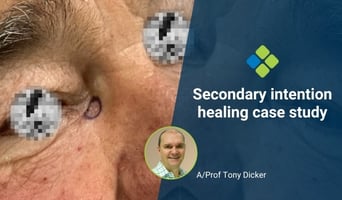 secondary intention healing