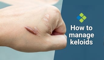keloids