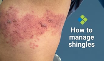 shingles
