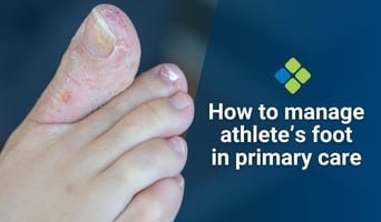 athlete's foot