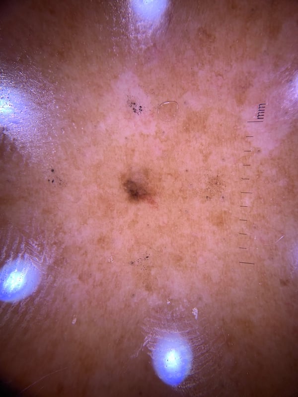 Case 2 Central Back  Dermatoscopic