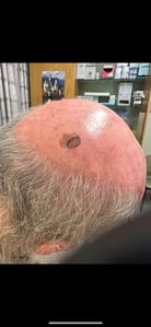 Clinical-image-scalp-lesion-15-May-2023