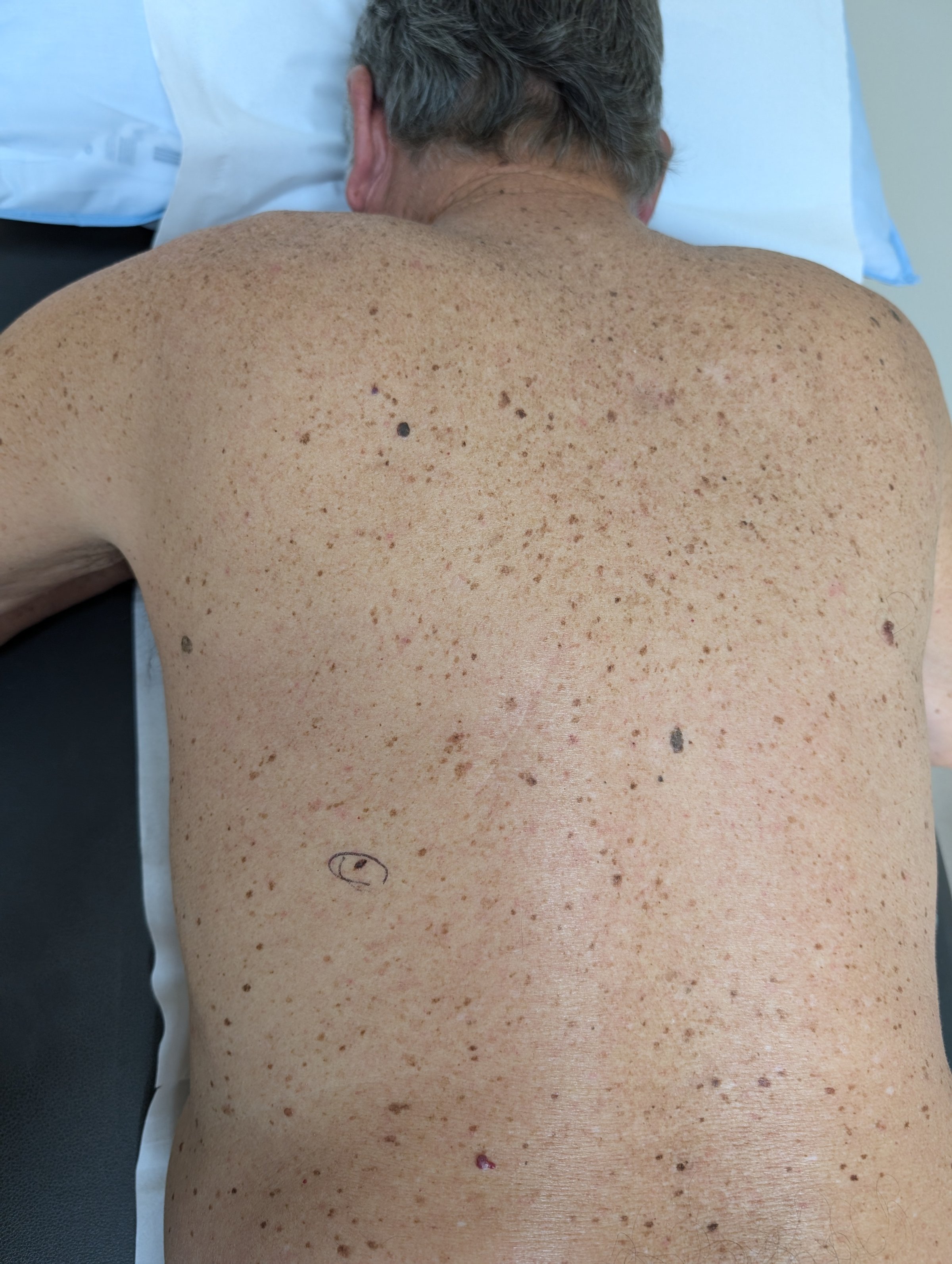 How would you manage this lesion on the back?