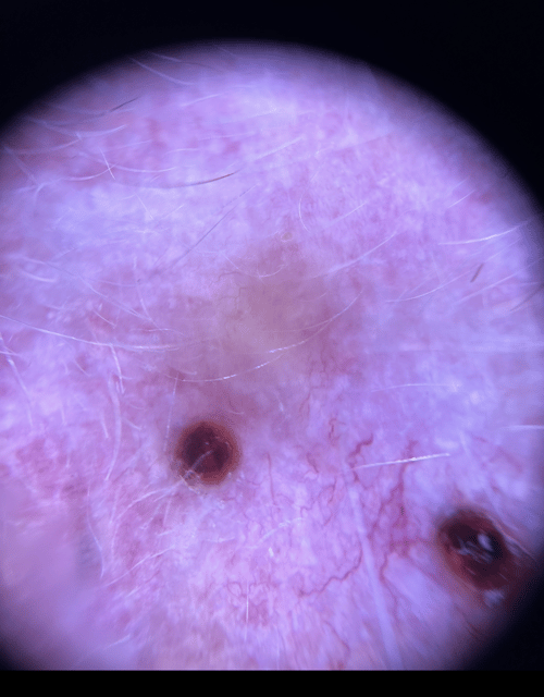 Dermoscopy both lesions