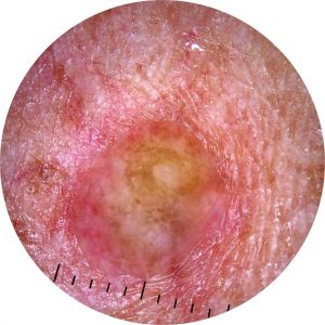 Dermoscopy image 1 May 2023