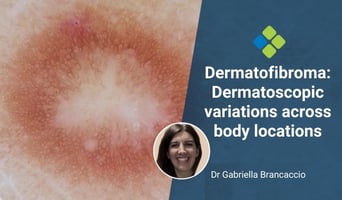 dermatofibroma
