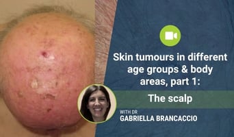 scalp tumours