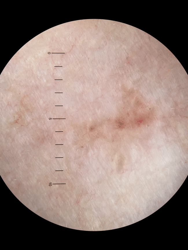 Left anterior shoulder Dermatoscopy