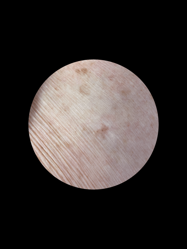 Left anterior shoulder macroscopic