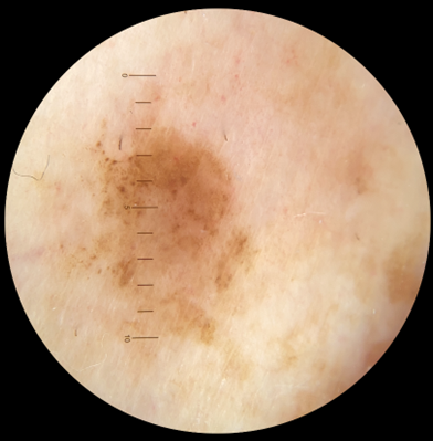Left lateral proximal lower leg Dermatoscopic Image-1