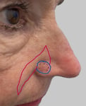 Option 2 - Shark Island Pedicle advancement flap - Picture7