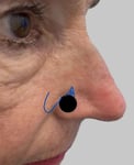 Option 3 - Transposition Flap - Picture7