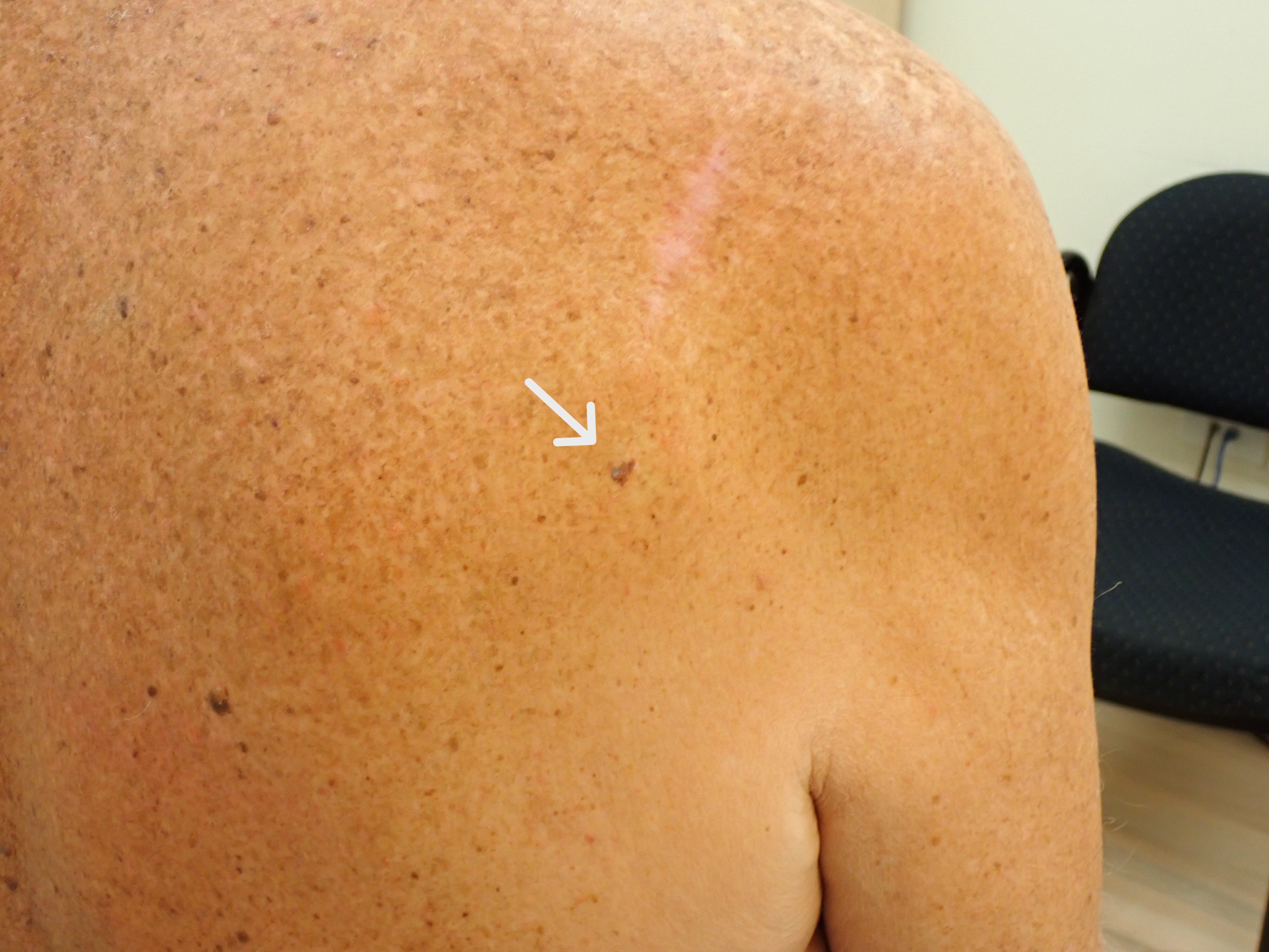 How would you manage this suspicious scapula lesion?