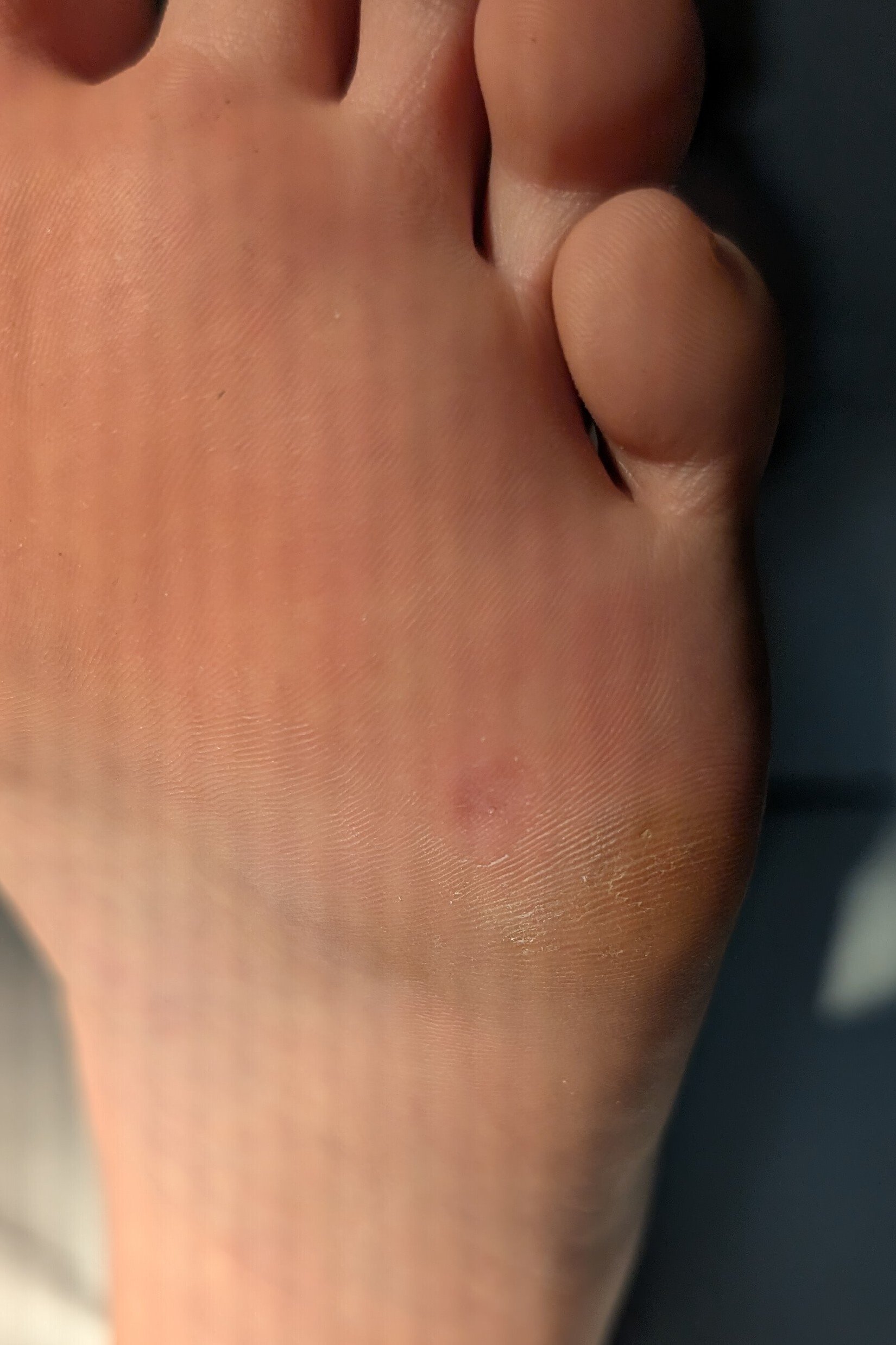 What do you think of this lesion on the foot?