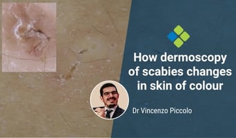 scabies in skin of colour