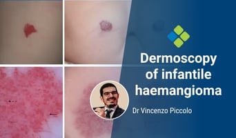 infantile haemangioma