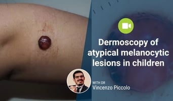 atypical melanocytic lesions in children