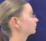 after 4 months (2)