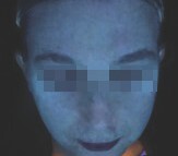 after 4 months under Skinscope UV illumination (1)