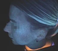 after 4 months under Skinscope UV illumination (2)