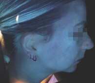after 4 months under Skinscope UV illumination (3)