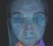 before under Skinscope UV illumination (1)