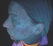 before under Skinscope UV illumination (2)