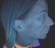 before under Skinscope UV illumination (3)