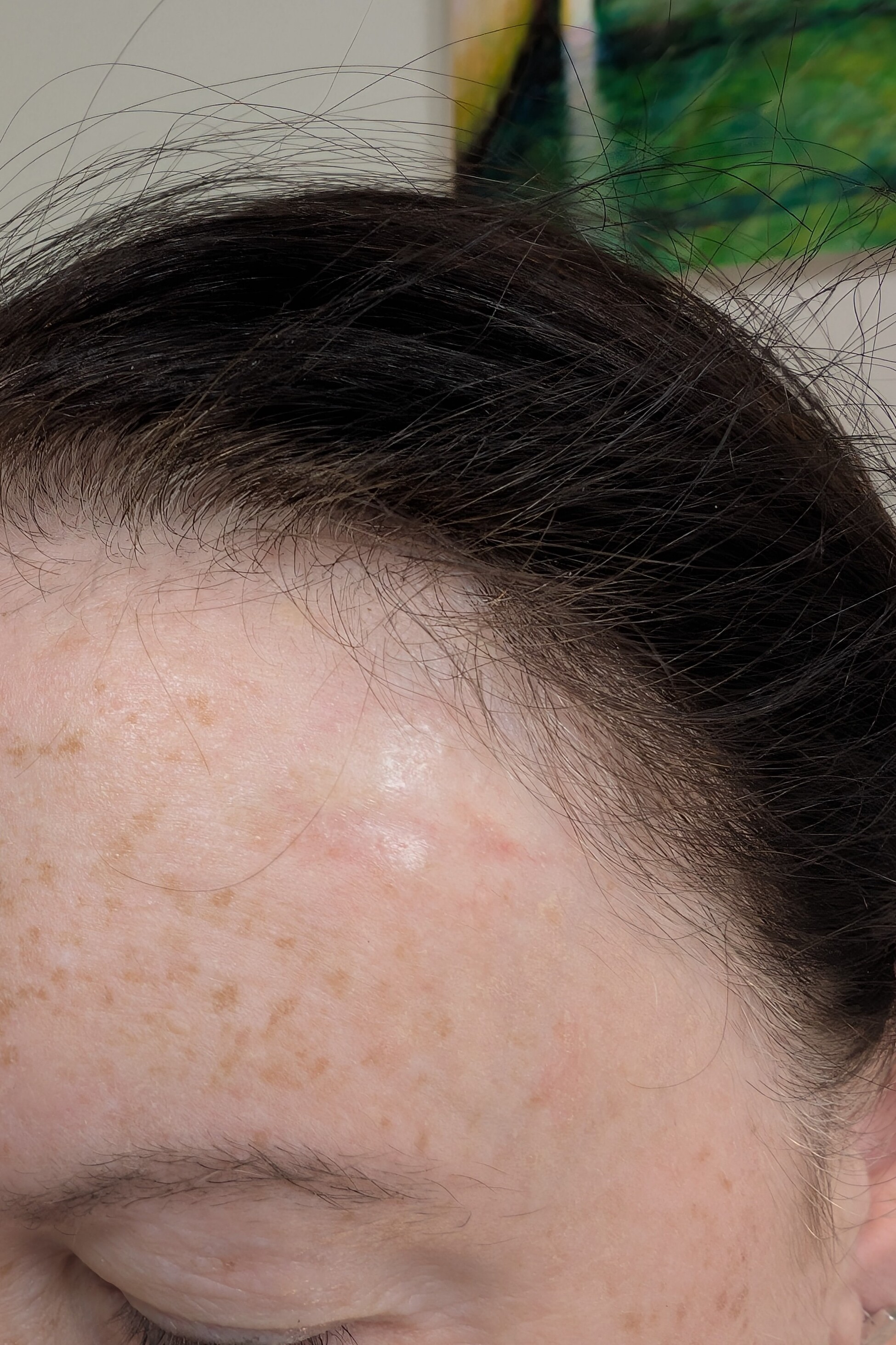 How would you manage this area on the forehead?