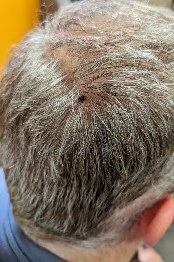 clinical scalp