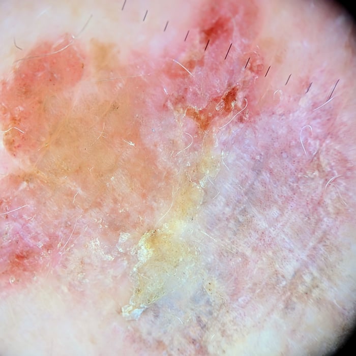 derm