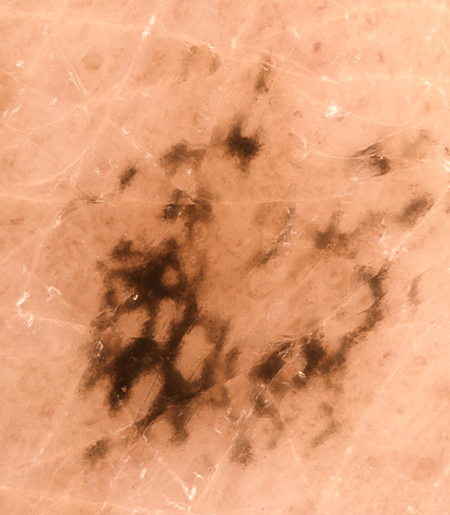 derm2