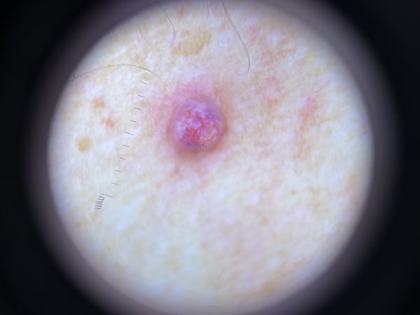 dermoscopy (3)