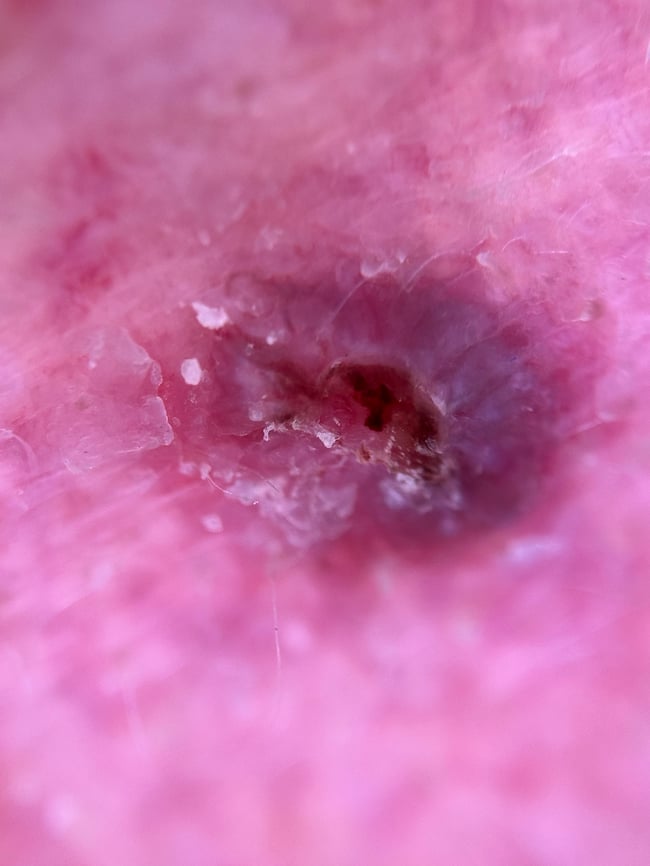 dermoscopy image 3