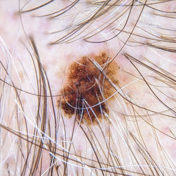 dermoscopy scalp
