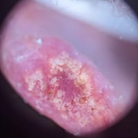 dermoscopy-image-ear-lesion-22-May-2023