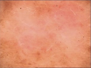 dermoscopy-image-lower-back-lesion-8-May-2023