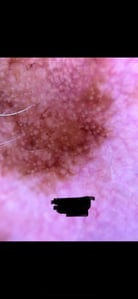 dermoscopy-image-scalp-lesion-15-May-2023-1