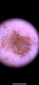 dermoscopy-image-scalp-lesion-15-May-2023-2