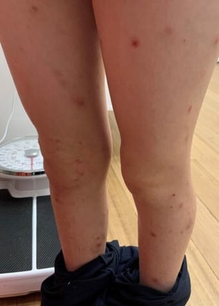 eczema1