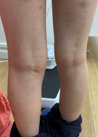 eczema2