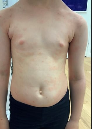 eczema4