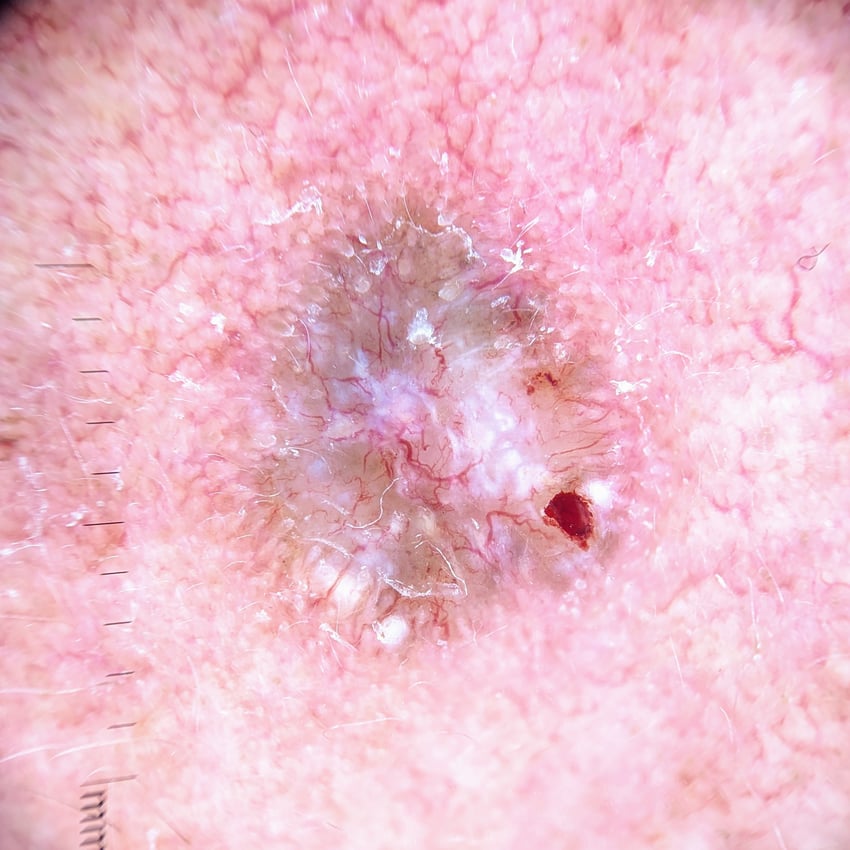 glabella derm