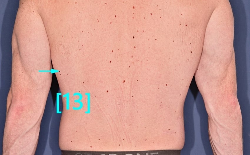 lesion 13 (1)