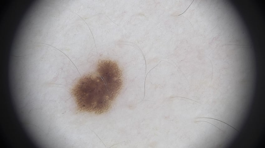 lesion 13 (2)