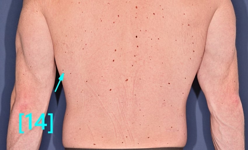 lesion 14 (1)