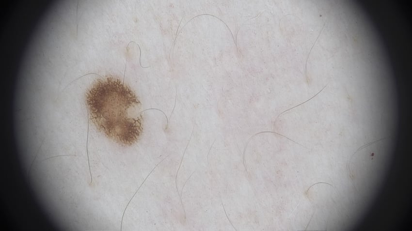 lesion 14 (2)