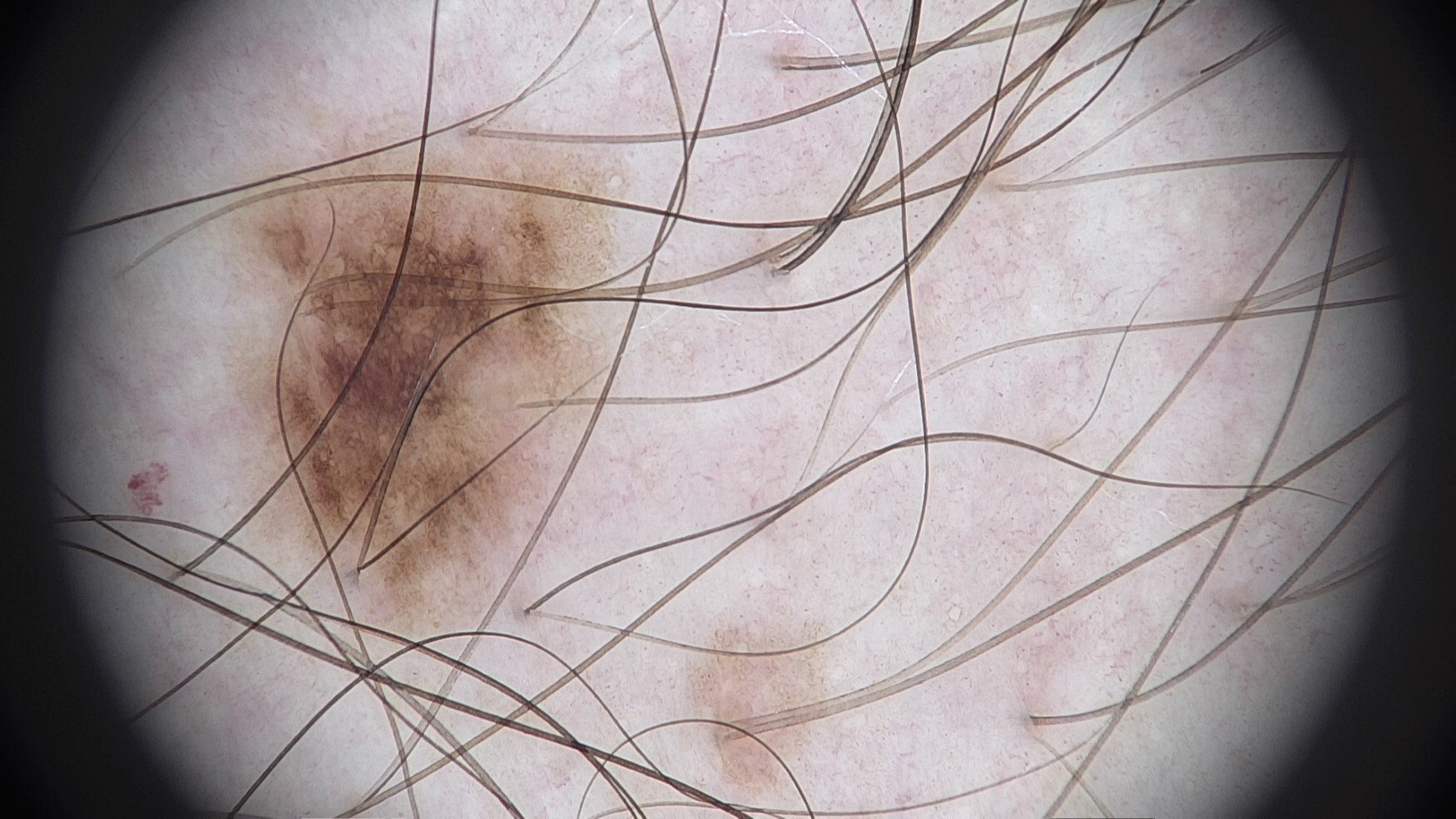 lesion 3 (2)