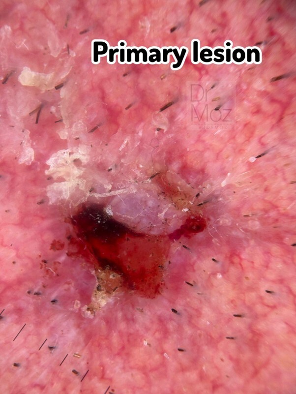 primary lesion